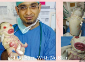 Baby born without skin in india