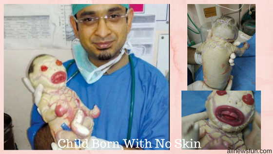 baby born without skin